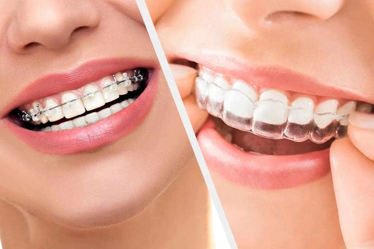 Aligner uso